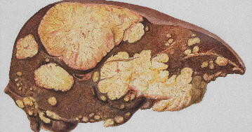 Fűszerrel a májkárosodás ellen